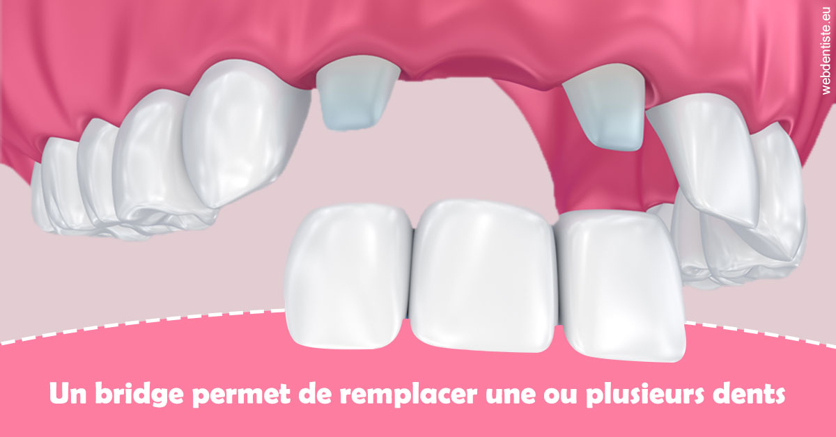 https://selarl-dr-jean-jacques-roux.chirurgiens-dentistes.fr/Bridge remplacer dents 2