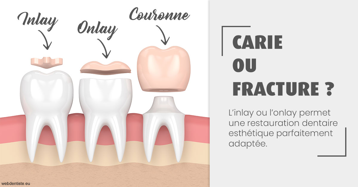 https://selarl-dr-jean-jacques-roux.chirurgiens-dentistes.fr/T2 2023 - Carie ou fracture 1