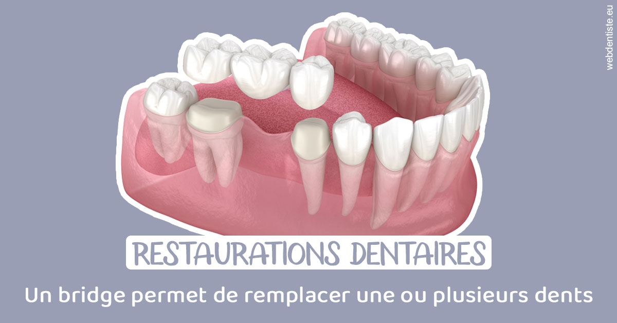 https://selarl-dr-jean-jacques-roux.chirurgiens-dentistes.fr/Bridge remplacer dents 1