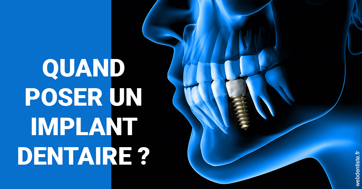 https://selarl-dr-jean-jacques-roux.chirurgiens-dentistes.fr/Les implants 1