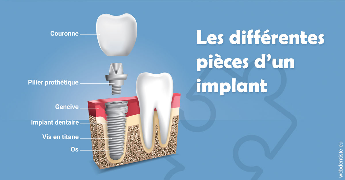 https://selarl-dr-jean-jacques-roux.chirurgiens-dentistes.fr/Les différentes pièces d’un implant 1